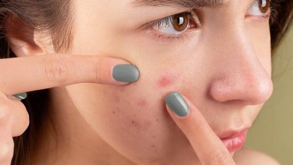 Skincare Untuk Menghilangkan Bekas Jerawat