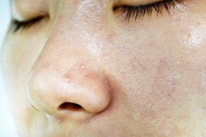 skincare routine untuk kulit berminyak dan berjerawat