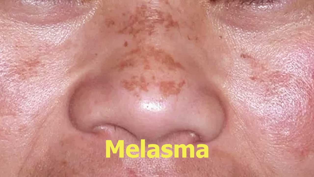 Masalah Kulit Melasma atau Hiperpigmentasi: Penyebab, Pencegahan, dan Cara Mengatasinya