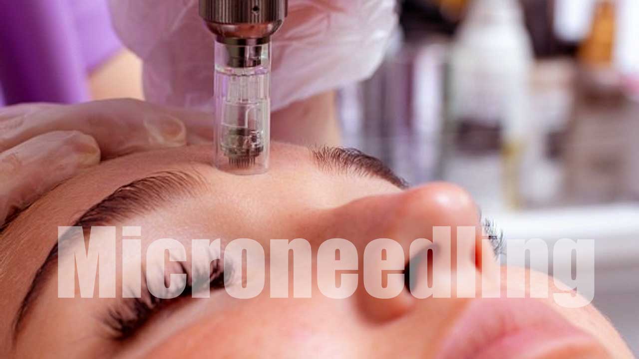 Microneedling: Rahasia Kulit Mulus Bebas Bekas Jerawat dan Penuaan!