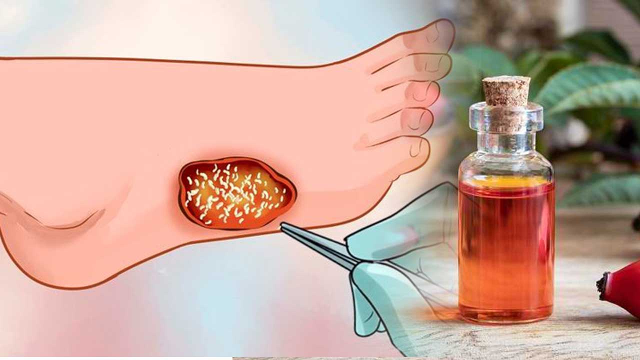 Manfaat Rosehip Oil untuk Mempercepat Penyembuhan Luka