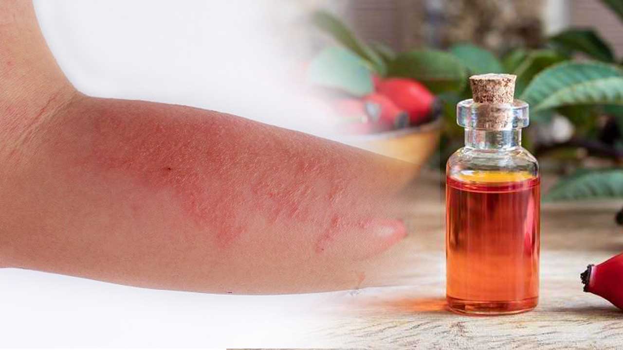 Manfaat Rosehip Oil untuk Mengatasi Peradangan dan Kemerahan pada kulit