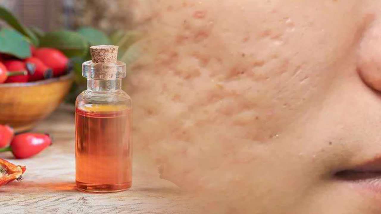 Manfaat Rosehip Oil untuk Menyamarkan Bekas Jerawat dan Hiperpigmentasi