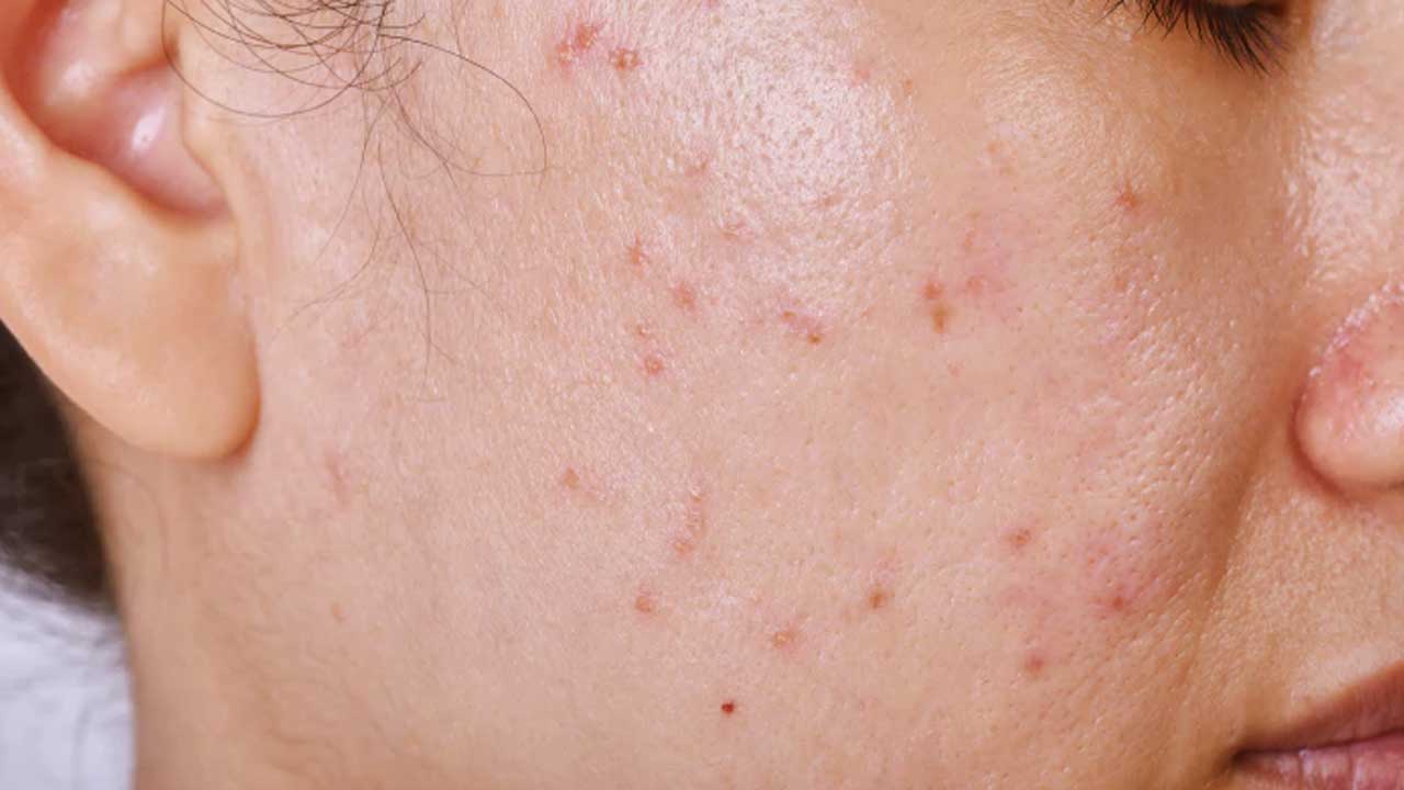Mengatasi Jerawat dengan Originote Salicylic Acid